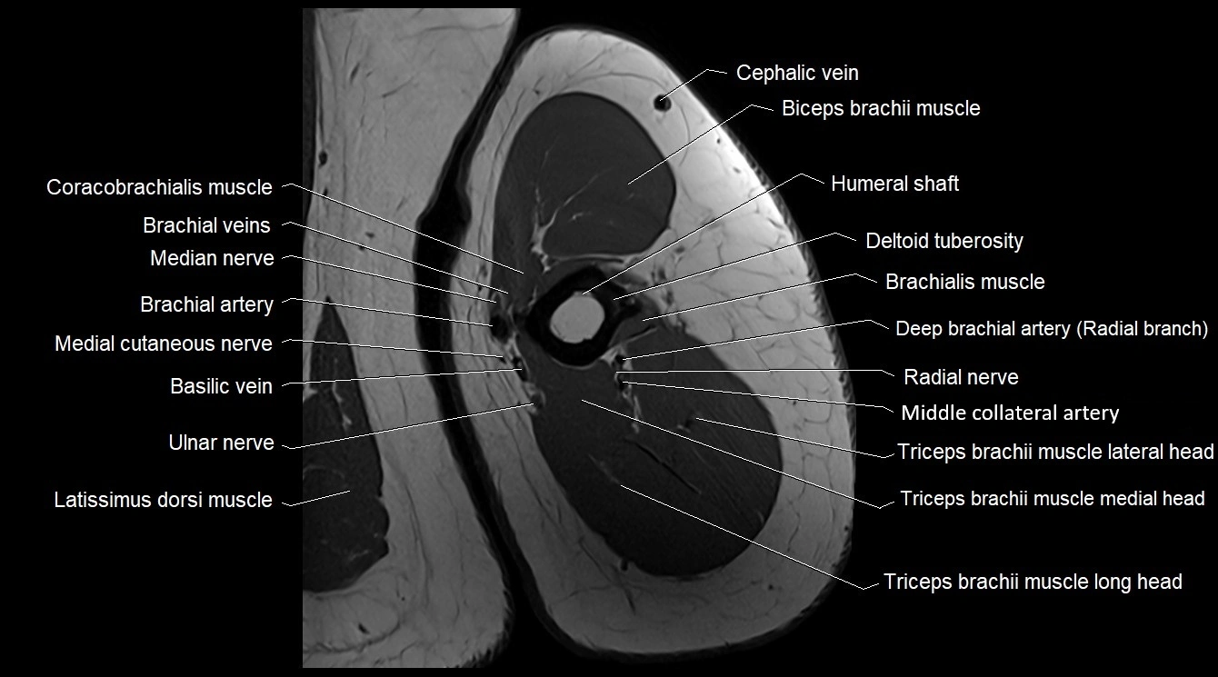 Upper arm( humerus) cross section anatomy MRI 3T axial image 31.webp